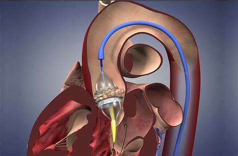 Conversations in Interventional Cardiology: Global Results from the Optimize PRO Study: Standardized TAVR Technique and Care Pathway